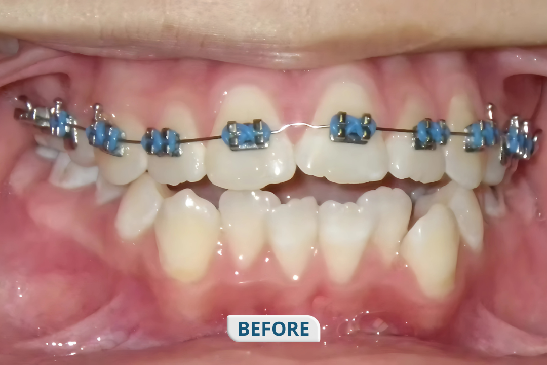 Before treatment at Namira Oro Dental Care